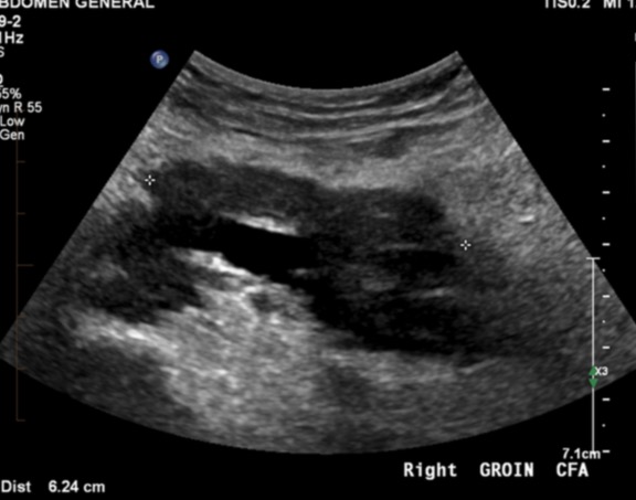 Figure 2 for case Vascular leiomyosarcoma ( RID4387 )